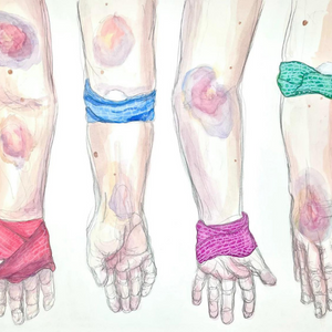 This artwork depicts the image of four lower forearms and hands/palms. Each pale arm is mottled with large blue and red bruises and dappled with freckles. Two of the arms have a tourniquet-like bandage wrapped around the bend in the elbow. The other two arms have a tourniquet-like bandaged wrapped in a crisscross pattern around the wrists. The bandages are each a separate color-red, blue, pink, green.